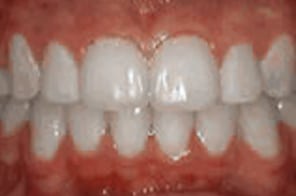 Straightened teeth with improved alignment after treatment.