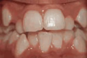 Crowded and overlapping teeth before orthodontic treatment.