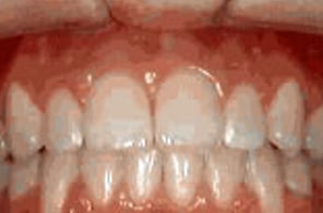 Corrected bite with upper and lower front teeth properly aligned.