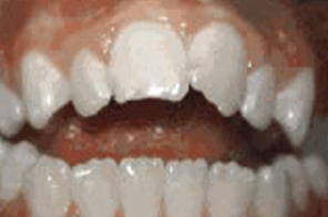 Open bite showing space between upper and lower front teeth.