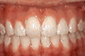 Corrected bite with upper and lower teeth aligned properly.