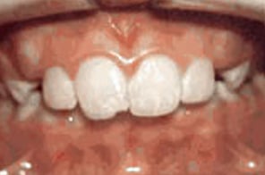 Child with severe overjet where upper front teeth protrude beyond the lower teeth.
