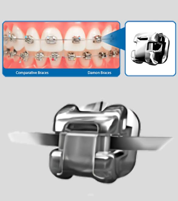 Orthodontic braces and dental equipment displayed for Elvebak Orthodontics treatment options