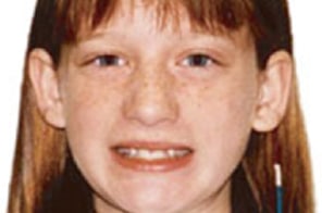 Before braces at Elvebak Orthodontics in Plano, TX, with crowded teeth.