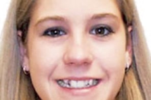 Before orthodontic treatment in Plano, TX, showing uneven teeth at Elvebak Orthodontics.