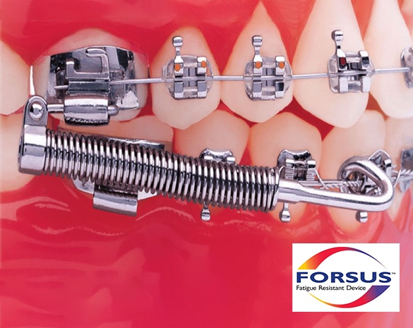 Forsus spring orthodontic appliance components displayed on red background with dental model.
