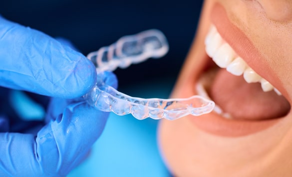 Orthodontist holding Invisalign clear aligner near patient's teeth