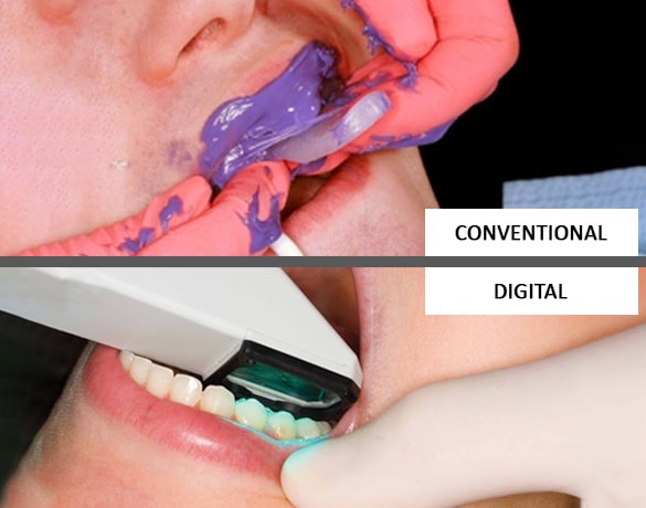 Comparison of conventional and digital orthodontic impressions being taken in a dental setting.