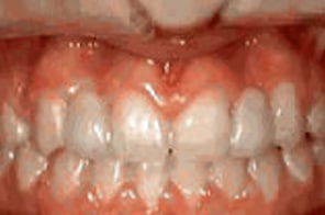 Completed smile with replaced lateral incisors and proper alignment.