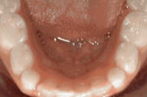 Natural alignment of lower teeth after space was created without braces.