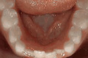 Young patient with crowding in lower front teeth and uneven alignment.
