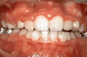 Improved spacing and aligned permanent incisors without braces.