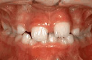 Child with crowded baby teeth and misaligned lower incisors.