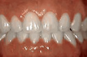 Evenly aligned teeth with gaps successfully closed.