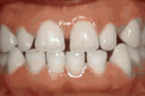 Noticeable gaps and spaces between front teeth.