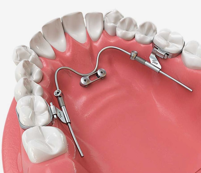 Dental model showing orthodontic brackets and wires attached to teeth for alignment treatment.