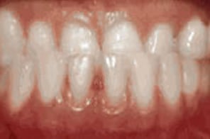 Underbite with lower front teeth positioned ahead of upper teeth.