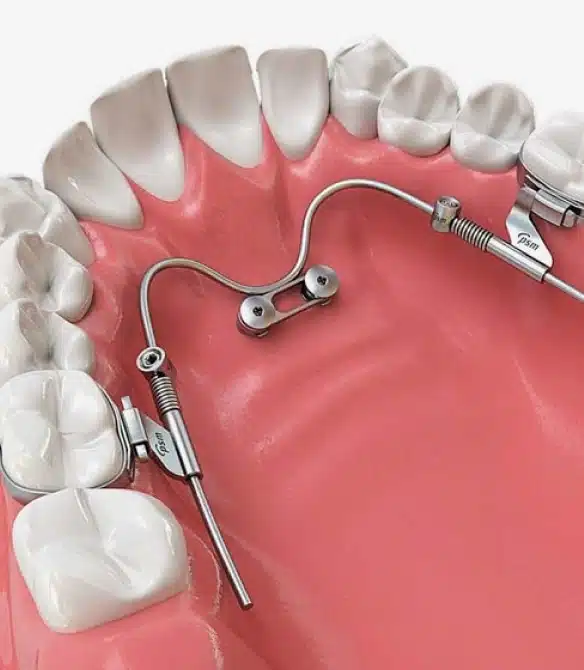 Dental implant model showing teeth and orthodontic hardware on pink gum display.